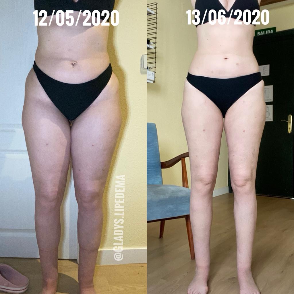 piernas antes y después de lipedema