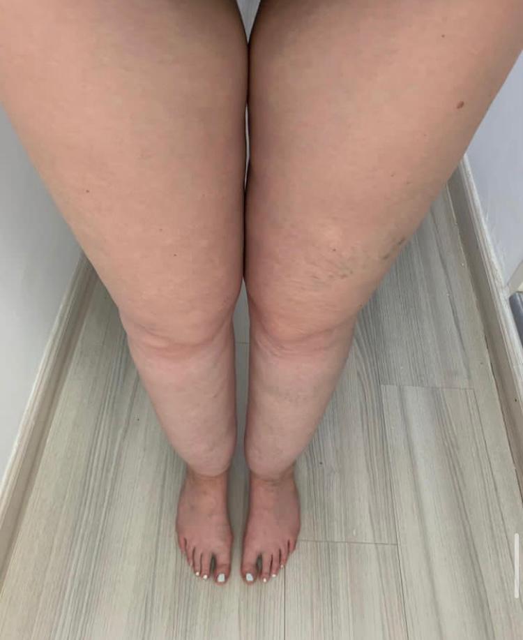 Piernas con lipedema