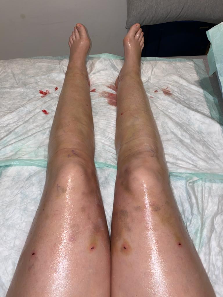 rutina postoperatorio de lipedema