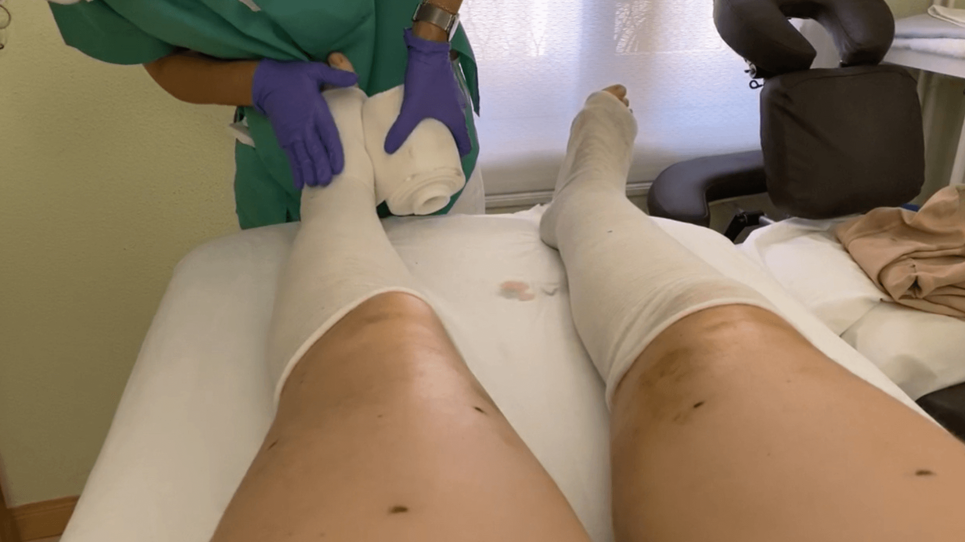 1 Mi experiencia con la fisioterapia en mi postoperatorio de lipedema